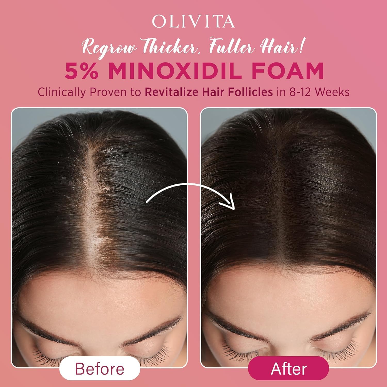 Minoxidil Hair Regrowth Foam Treatment Pack
